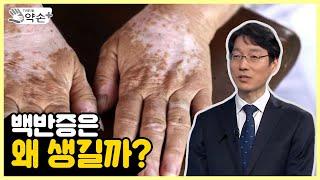 백반증은 왜 생길까? [피부의 흰색 반점? 백반증 제대로 알기 ③] | 메디컬 약손