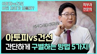 가렵다고 다 아토피가 아니에요!! ㅣ아토피와 건선을 구별하는 방법 5가지