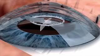 Watch live surgery using the laser cataract system - how does it work? Eye News TV