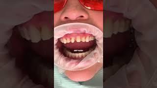 Composite vs porcelain veneers | which is best for you? | Dr. Yazdan | veneers before and after