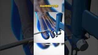 How Hammer Toes Surgery has done #simplihow #zackdfilms #medcare