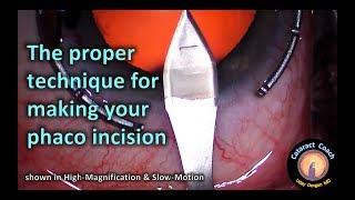 Close Up: Technique for Phaco Incision in Cataract Surgery