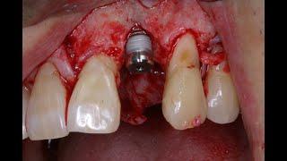 Simple 3 D ridge augmentation using Stickybone and a tenting abutment.