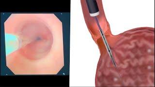 Schatzki's Ring Endoscopic Balloon Dilation to Improve Swallowing