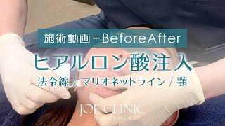 【施術動画＆BeforeAfter】ヒアルロン酸注入（頬～顎）| ジョウクリニック