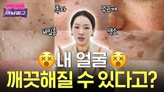 점, 기미, 주근깨, 잡티? 레이저 종류 및 치료법부터 후 관리까지 싹 다 알려줄게!!! #색소치료 #레이저토닝