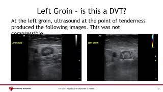 UH CMC ED - Ultrasound Cases  #3: DVT vs lymph node