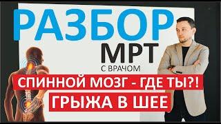 Разбор МРТ. Грыжа позвоночника. Павел Валерьевич Платонов. Самара