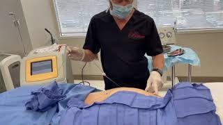 SmartLipo procedure with Dr. Berman