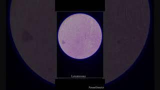 leiomyoma, papillary carcinoma, squamous cell,basal cell carcinoma, colloidal goitre #youtubeshorts