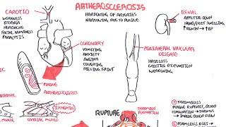 Atherosclerosis - Pathophysiology