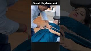 Navel displacement treatment in India by dr harish grover #trend #ytshort #shortfeed