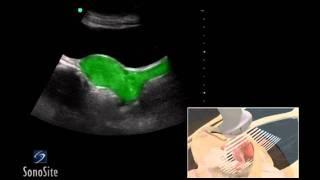 How To: Female Pelvis Ultrasound Exam 3D Video