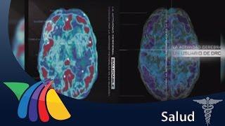 Efectos de las drogas en el cerebro | Noticias de Salud