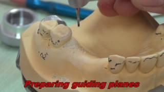 1- Rest Seat Preparation ( for partial denture Construction )