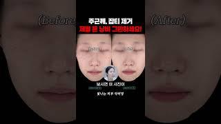 최고의 가성비 시술?! 1회만에 효과 봐요! #주근깨 #잡티제거 #잡티