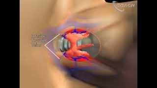 Surgery for Thyroid Disease: Minimally Invasive Thyroid Lobectomy