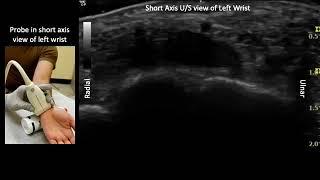 Ulnar Nerve Anatomy and US-Guided Injection