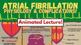 Atrial Fibrillation (pathophysiology and implications for care) made easy!