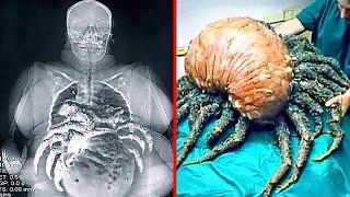 15 Craziest Things Ever Found Inside The Human Body