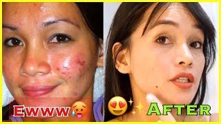 HOW I CLEARED MY ACNE? SKINCARE ROUTINE || PHILIPPINE DERMATOLOGIST || MEDISKIN