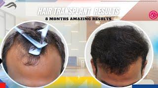 Hair Transplant In Salem | Best  Cost Surgeon Center & Results Of Hair Transplant In Salem