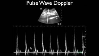 Ultrasound Physics Scanning Modes Pulsed Wave Doppler