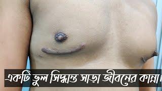 অপারেশন করানো জীবনের সব চেয়ে বড় ভুল ||  Gynecomastia  || পুরুষের বড় স্তন || ছেলেদের স্তন ||