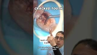 How to Treat a Symptomatic Cracked Tooth | In Office to Hands On Dental Training #shorts