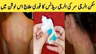 Skin Allergy Treatment || Redness | Itching || Scalp itching || By Sanam Ansari ||