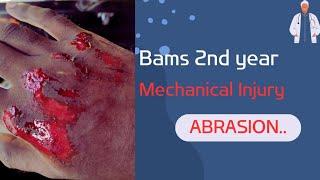 Abrasion |Type of Mechanical Injury | FMT | Agadtantra | Forensic medicine