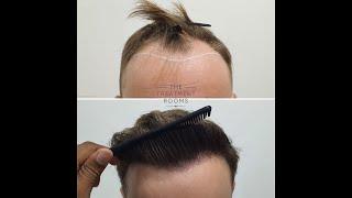 1724 grafts FUE Hair Transplant Result- The Treatment Rooms London, Hair Transplant Clinic