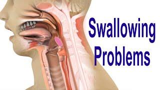 Swallowing Problems or Dysphagia: Top 4 Possible Causes Including Cricopharyngeal Dysfunction (CPD)