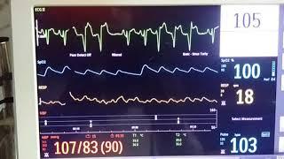 Ventricular Bigemini and Trigemini