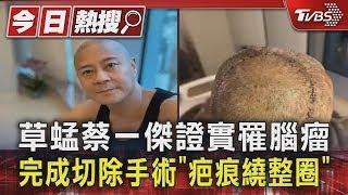 草蜢蔡一傑證實罹腦瘤 完成切除手術「疤痕繞整圈」｜TVBS新聞