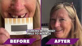  Step 3: The Final Smile Reveal! 
