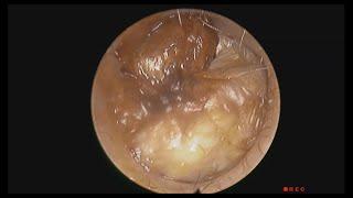 Earwax, Fungal Infection and Eardrum Perforation