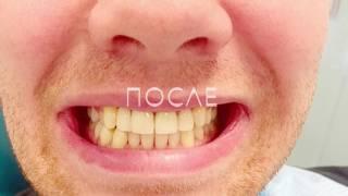 Виниры в Перми, установка в стоматологии Эстет