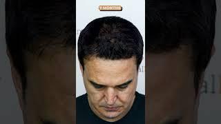 Amazing Hair Transplantation Result!