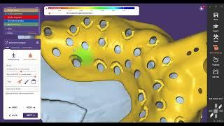 Custom Tray design in Exocad #digitaldentistry #implants #exocad