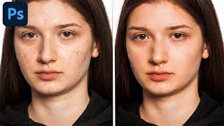 Remove Scars (Easiest Way) : Photoshop Tutorial #2