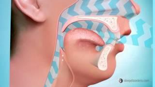 What is obstructive sleep apnea? - Dr. Richard Jacobson