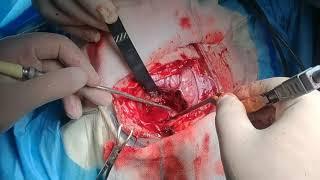 فیلم جراحی ضایعه عروقی مغز در دختر جوان