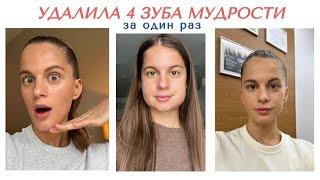 VLOG: удалила 4 зуба мудрости под седацией, моя реабилитация, сколько стоит?