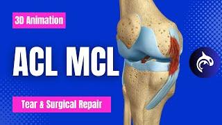 ACL and MCL Tear and Surgical Repair - 3D Animation