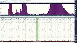 Практичний онлайн майстер-клас ECGpro Holter 22/12/2022