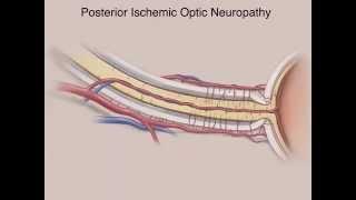 Ischemic Optic Neuropathies