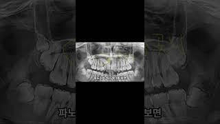 오른쪽 위 송곳니가 없어요.
