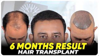 Hair Transplant in Eluru | Best Results & Cost of Hair Transplant in Eluru