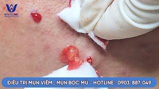 NẶN MỤN VIÊM, MỤN BỌC MỦ TẠI PHÒNG KHÁM DA LIỄU HHV CLINIC | PHƯỜNG 13, Q. TÂN BÌNH, TP HỒ CHÍ MINH.